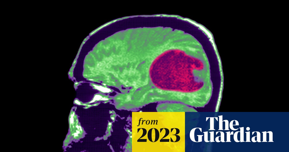 New AI tool can help treat brain tumors more quickly and accurately